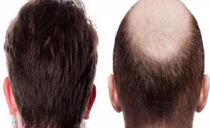 فوری فوری؛ افرادی مشکل «ریزش مو» دارند حتما بخوانند| درمان ریزش مو با نتایج موفق و دائمی