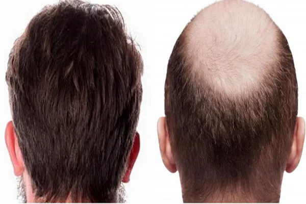 فوری فوری؛ افرادی مشکل «ریزش مو» دارند حتما بخوانند| درمان ریزش مو با نتایج موفق و دائمی