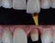 آیا کامپوزیت ونیر باعث پوسیدگی دندان میشود؟ همه چیز راجع‌به کامپوزیت مشهد