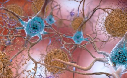 سلول های گلیال و تشکیل پلاک در مغز آلزایمر