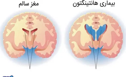 بیماری هانتیگتون/تاثیرات بیماری هانتینگتون(HD) بر روی مغز تا چه اندازه است؟