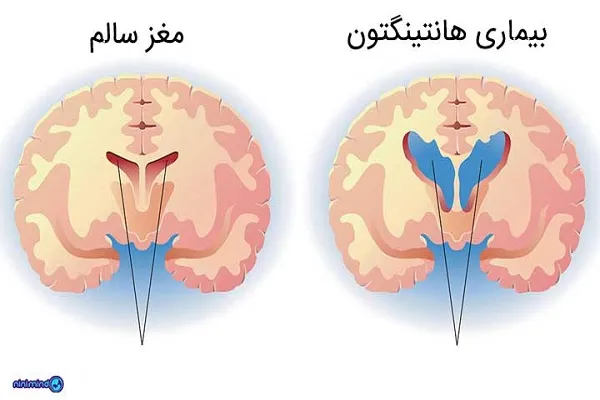 بیماری هانتیگتون/تاثیرات بیماری هانتینگتون(HD) بر روی مغز تا چه اندازه است؟