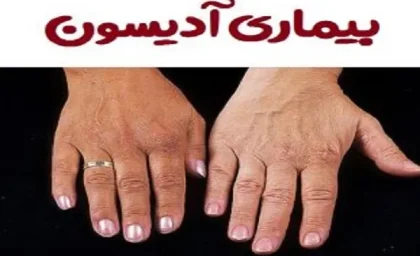 بیماری آدیسون/علائم و نشانه های بیماری آدیسون یا نارسایی غده فوق کلیه چیست؟
