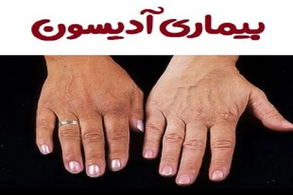 بیماری آدیسون/علائم و نشانه های بیماری آدیسون یا نارسایی غده فوق کلیه چیست؟
