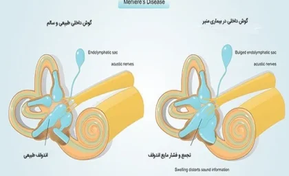 بیماری منیر چیست؟/هر چیزی که باید درمورد بیماری منیر بدانید