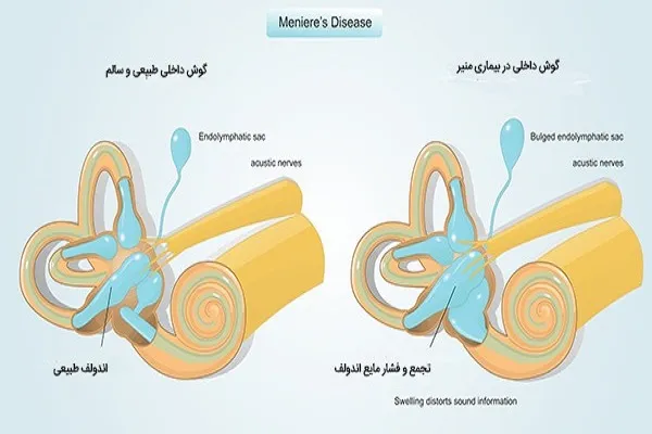 بیماری منیر چیست؟/هر چیزی که باید درمورد بیماری منیر بدانید