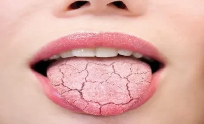 خشکی دهان نشانه چیست/مصرف چه داروهایی باعث ایجاد بیماری خشکی دهان می شود؟