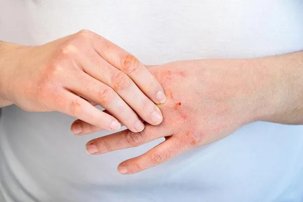 بیماری خود ایمنی پوستی چیست|آیا علائم بیماری خود ایمنی پسوریازیس با HIV یکسان است؟
