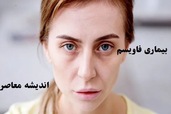 بیماری فاویسم|دنیای خطرناک افراد مبتلا به فاویسم که یک لقمه باقالا می‌تواند جان شما را به خطر بیندازد!