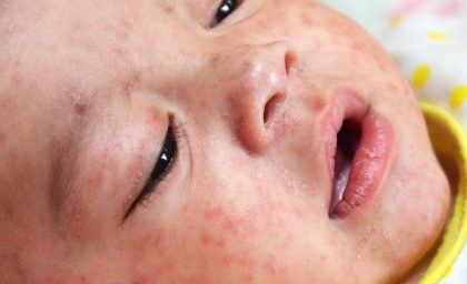 آیا سرخک باعث آسیب مغزی می شود؟ بله ، در اینجا چگونه اتفاق می افتد