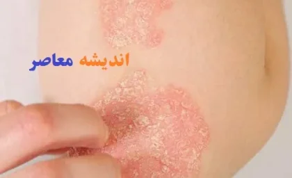 بیماری پسوریازیس چیه/پسوریازیس شما بدتر شده؟شاید این غذاها دلیلش باشند!