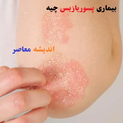 بیماری پسوریازیس چیه/پسوریازیس شما بدتر شده؟شاید این غذاها دلیلش باشند!