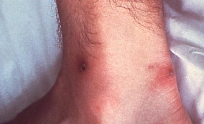شیوع STI در آلاسکا | روانشناسی امروز