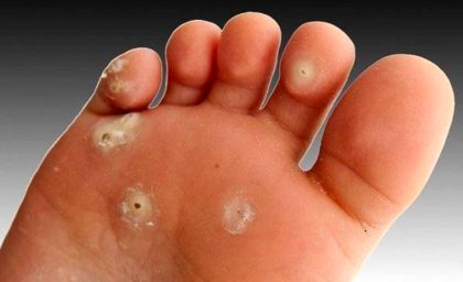 میخچه پا چیست و چگونه درمان می‌شود؟