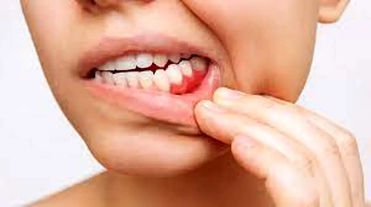 درد لثه و فک پایین؛ چه چیزی باعث آن می‌شود؟ | نکات مهم پزشکی/ علت درد لثه و فک پایین | از مشکلات دندان تا بیماری‌های دیگر
