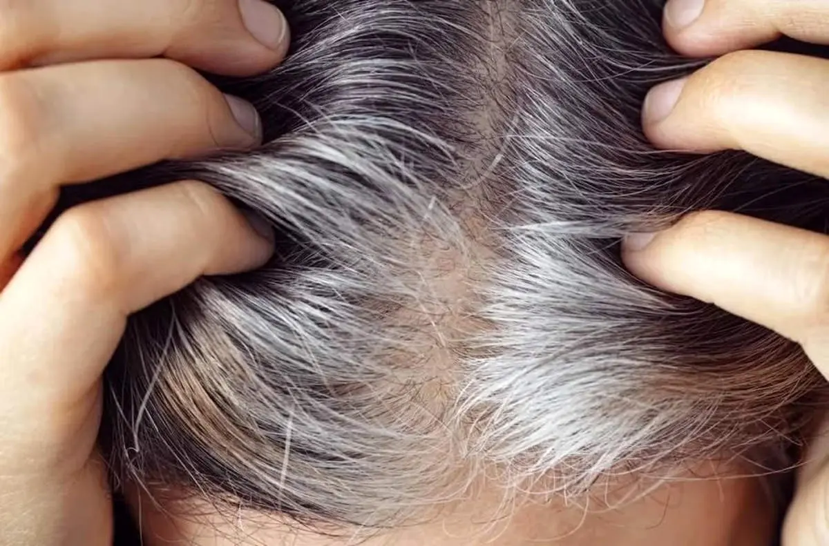 ریزش مو؛ زنگ خطر بدن برای یک بیماری جدی / چه علائمی همراه آن ظاهر می‌شود؟ / نکات حیاتی که همه باید بدانند