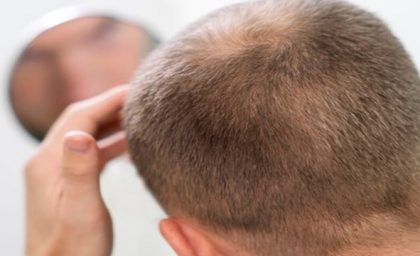 بررسی قدم به قدم مراحل کاشت مو