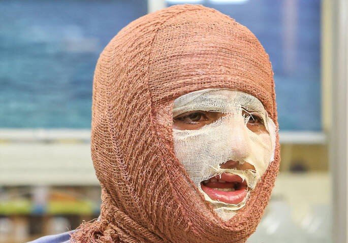 بهبود کامل پس از سوختگی‌های عمیق همه را شگفت‌زده کرد / حقیقتی درباره بهبود کامل پس از سوختگی‌های عمیق که کمتر گفته می‌شود / امید بزرگ برای بیماران سوختگی منتشر شد