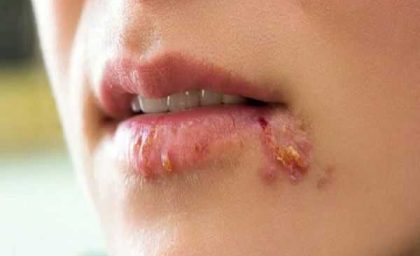 اخبار پزشکی تاثیر استرس بر تبخال | چرا استرس باعث تشدید تبخال می‌شود؟ / هورمون‌های استرس سیستم ایمنی را تضعیف و ویروس را فعال می‌کنند + راهکارهای سریع کاهش استرس و جلوگیری از عود