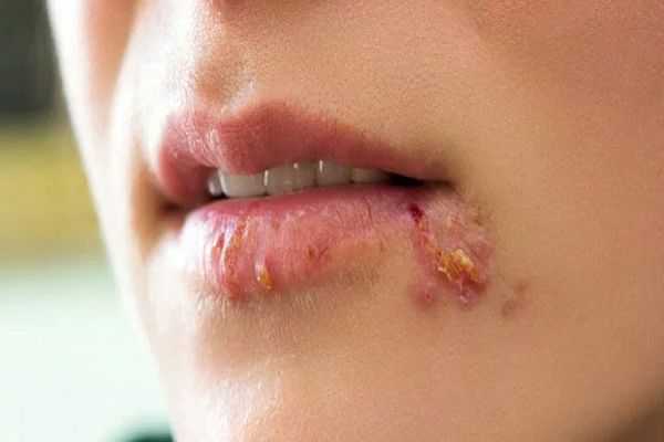 اخبار پزشکی تاثیر استرس بر تبخال | چرا استرس باعث تشدید تبخال می‌شود؟ / هورمون‌های استرس سیستم ایمنی را تضعیف و ویروس را فعال می‌کنند + راهکارهای سریع کاهش استرس و جلوگیری از عود