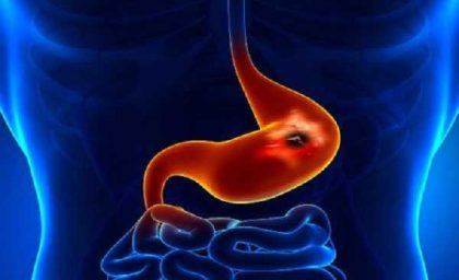 این خوراکی‌ها بلای جان معده‌اند / اگر سوءهاضمه دارید، مصرف این غذاها می‌تواند علائم را تشدید کند / از نفخ و دل‌درد تا احساس سنگینی؛ بخوانید