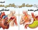تفاوت حمله قلبی و رفلاکس معده؛ راهنمای کامل تشخیص دو عارضه با علائم مشابه