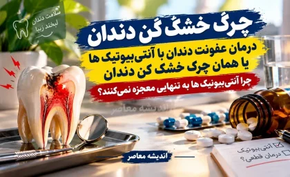 چرک خشک کن دندان | درمان عفونت دندان با آنتی‌ بیوتیک‌ ها یا همان چرک خشک کن دندان / چرا آنتی‌ بیوتیک‌ ها به تنهایی معجزه نمی‌کنند؟